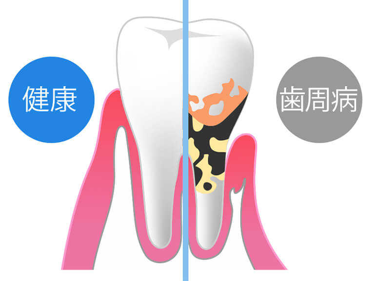 健康な歯と歯周病
